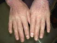 銀屑病性關(guān)節(jié)炎