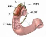 慢性膽囊炎