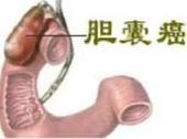 膽囊癌 膽囊癌