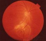 水痘-帶狀皰疹性葡萄膜炎