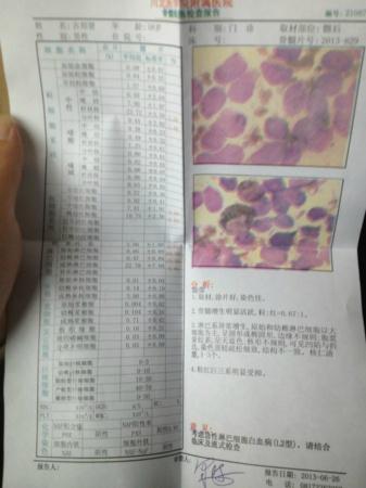 急性淋巴細胞白血病 急性淋巴細胞白血病