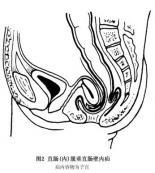 直腸脫垂直腸壁內疝 直腸脫垂直腸壁內疝