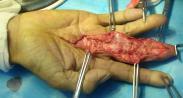 化膿性腱鞘炎