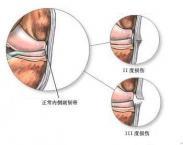 膝關(guān)節(jié)側(cè)副韌帶損傷