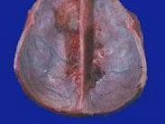 多發(fā)性腦膜瘤 多發(fā)性腦膜瘤