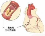 心血管和血栓栓塞綜合征